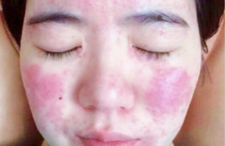 珍妮膚護(hù)膚小技巧：激素臉如何護(hù)理？